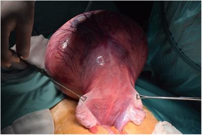 Uterine leiomyoma in pediatric population: A case report and review of the literature